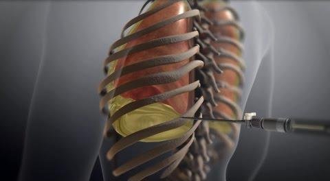Study Finds Equal Comfort in Thoracentesis Drainage Methods