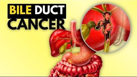 Rare Biliary Tract Cancer in Children: Diagnosis and Treatment