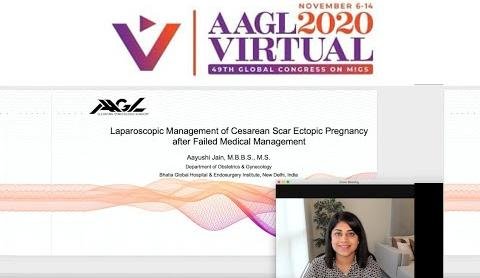 Managing Cesarean Scar Ectopic Pregnancies: Expert Insights on Treatment