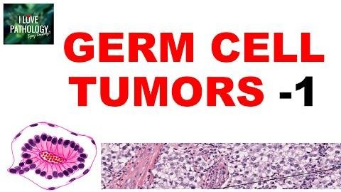 Challenges of Diagnosing and Treating Ovarian Yolk Sac Tumors