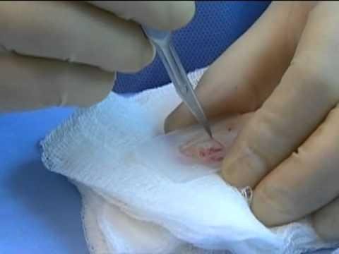 Vitrification Outperforms Slow-Freezing in Ovarian Tissue Preservation Study