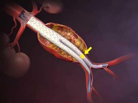 Study Reveals Interconnectedness of Abdominal Aortic Aneurysm and Renal Artery Stenosis