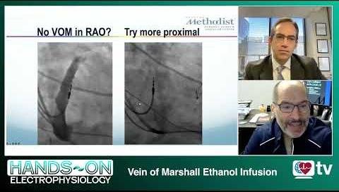 Ethanol Ablation of Marshall Vein: Transformative Treatment for Tachycardia