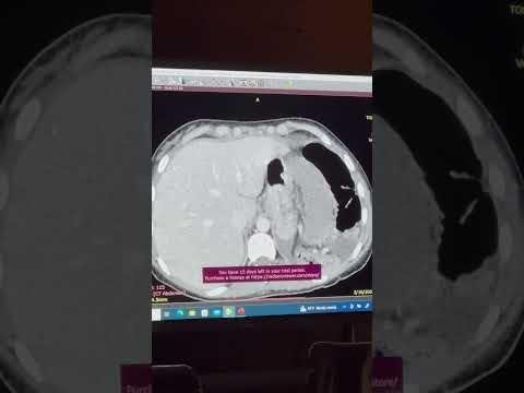 Splenic Torsion: Unveiling Rare Abdominal Complications in Biliary Stenting