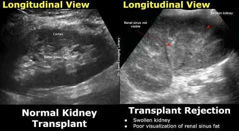 Ultrasound Breakthrough Enhances Kidney Transplant Viability