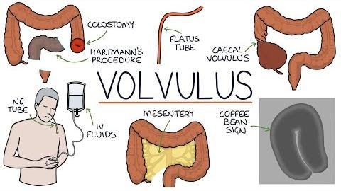 Innovative Surgical Technique Transforms Sigmoid Volvulus Management