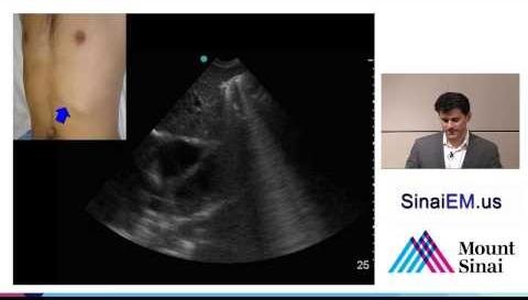 Researchers Uncover Groundbreaking Physics Discovery with Ultrasound and Droplets
