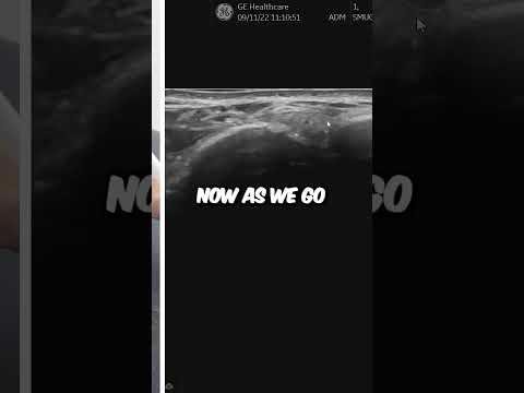 Innovative Ultrasound Trial Enhances Ankle Injury Diagnosis at Redland Hospital