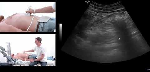 Transabdominal Ultrasound Shows Promise in Monitoring Pancreatic Lesions