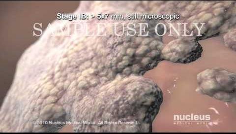 Machine Learning Enhances Cervical Cancer Staging Accuracy