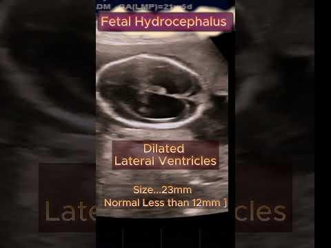 Ultrasound Delivery of Creatine Targets Children’s Neurological Disorders