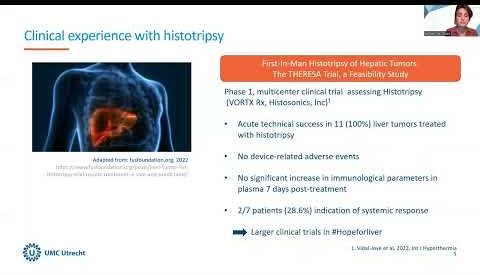 Study Reveals Histotripsy’s Immune-Boosting Impact on Melanoma Tumors