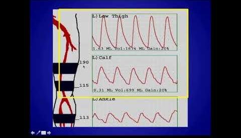Novel Ultrasound Technique Shows Promise in Detecting Peripheral Arterial Disease