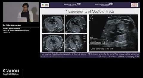 Study Reveals Key Ultrasound Parameters for Coarctation of Aorta