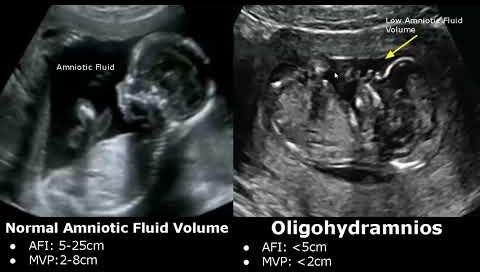 Study Reveals Link Between Amniotic Fluid and Fetal Weight