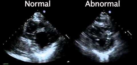 Echocardiogram: Essential Diagnostic Tool for Heart Conditions