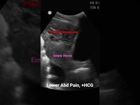 Rare Diaphragmatic Ectopic Pregnancy: Advanced Imaging Key for Diagnosis