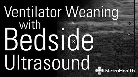 Speckle Tracking Ultrasound Predicts Success in Ventilator Weaning