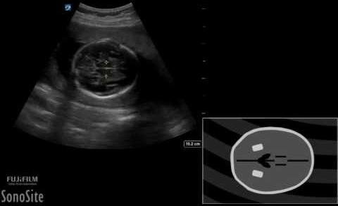 Deep Learning Enhances Fetal Weight Estimation Accuracy in Ultrasound