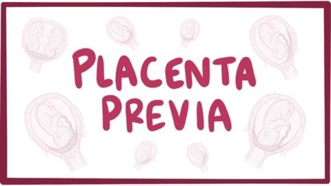 Study Reveals Key Risk Factors for Antepartum Hemorrhage in Placenta Accreta Spectrum