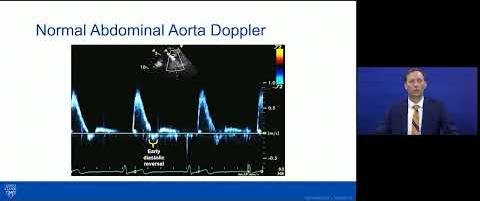 Abdominal Aortic Doppler Boosts Pediatric Aortic Coarctation Diagnosis