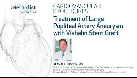 Popliteal Artery Aneurysm: Importance of Early Detection and Treatment