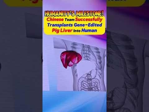 Chinese Man’s Pig Liver Transplant: A Milestone in Xenotransplantation
