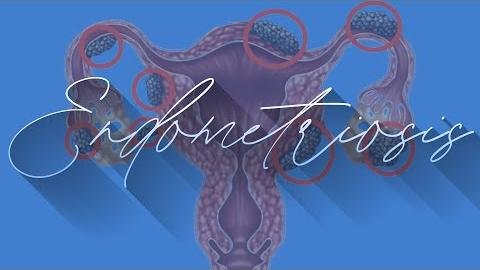 Mayo Clinic’s Dr. Adela Cope on Endometriosis Detection Challenges