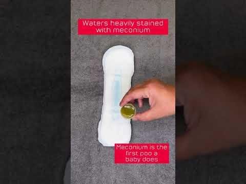 Understanding Your Water Breaking: Signs, Actions, and Implications