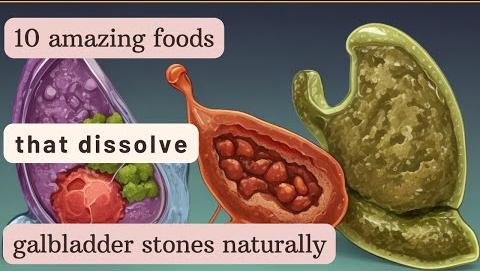 Intramural Stones in Gallbladder: Risk Factors and Treatment Insights