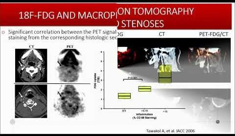 Contrast-Enhanced Ultrasound Predicts Stroke Risk in Carotid Plaque