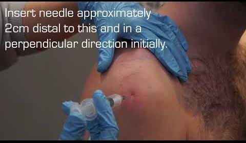 Subacromial Injections Show Promise in Treating Rotator Cuff Tendonitis